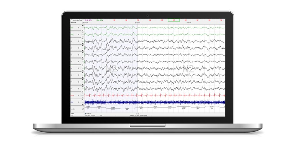 An example of the EEG raw data that is available.