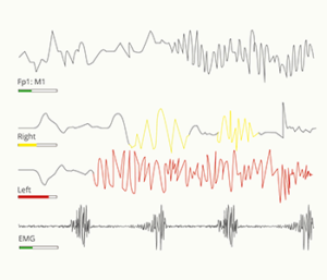 home-sleep-test-signale